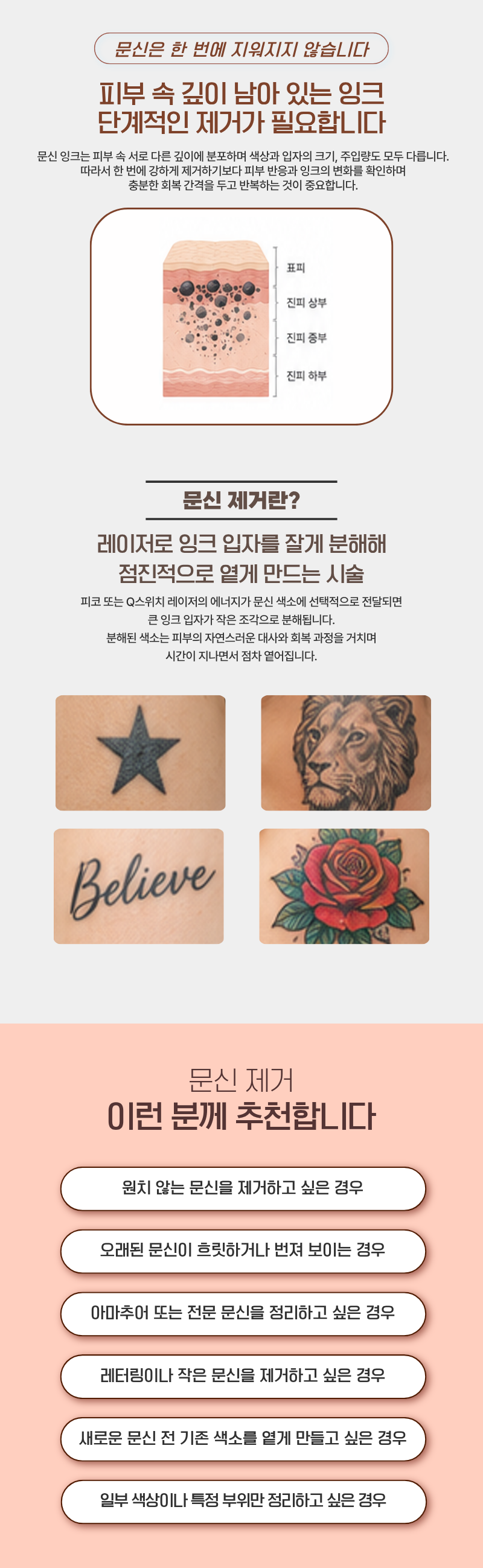 문신 제거 1