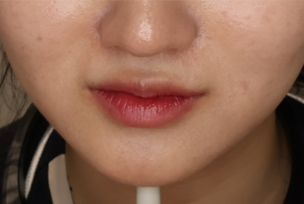 [팔자필러] — BEFORE
