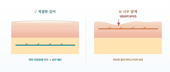 24편-실리프팅 부작용 총정리. 만져짐·울퉁불퉁·비대칭·염증