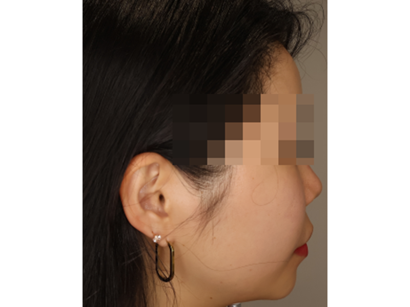 [퍼진 팔자필러 히알라제(용해)] — BEFORE