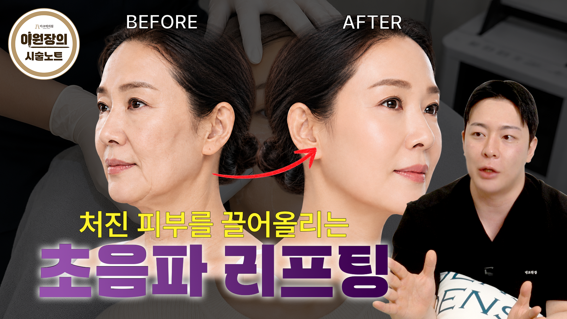초음파 리프팅, 과연 어떤 시술일까?|얼굴이 갸름해지는 초음파 리프팅의 모든 것!