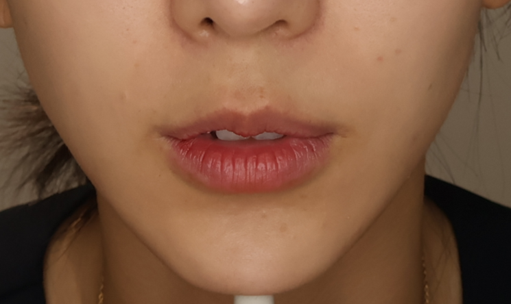 [입술필러] — BEFORE