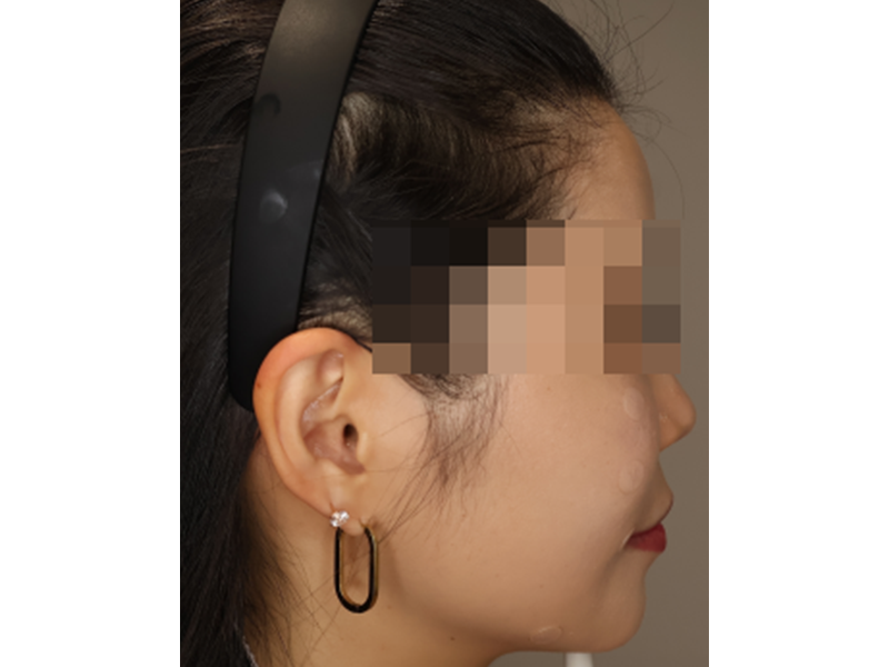 [퍼진 팔자필러 히알라제(용해)] — AFTER