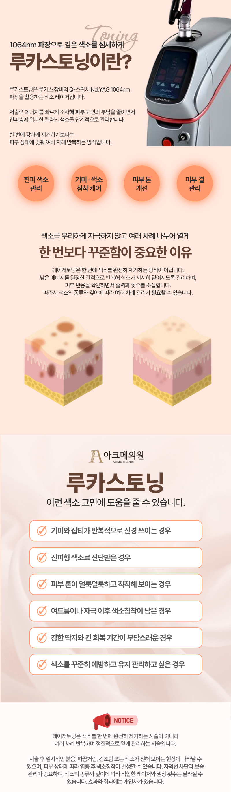 루카스토닝 (레이저 토닝) 1
