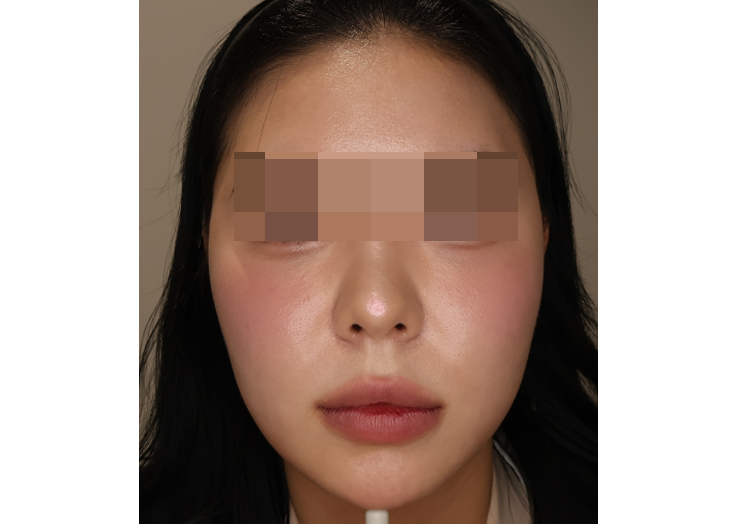 [옆광대 조각주사 4cc] — BEFORE