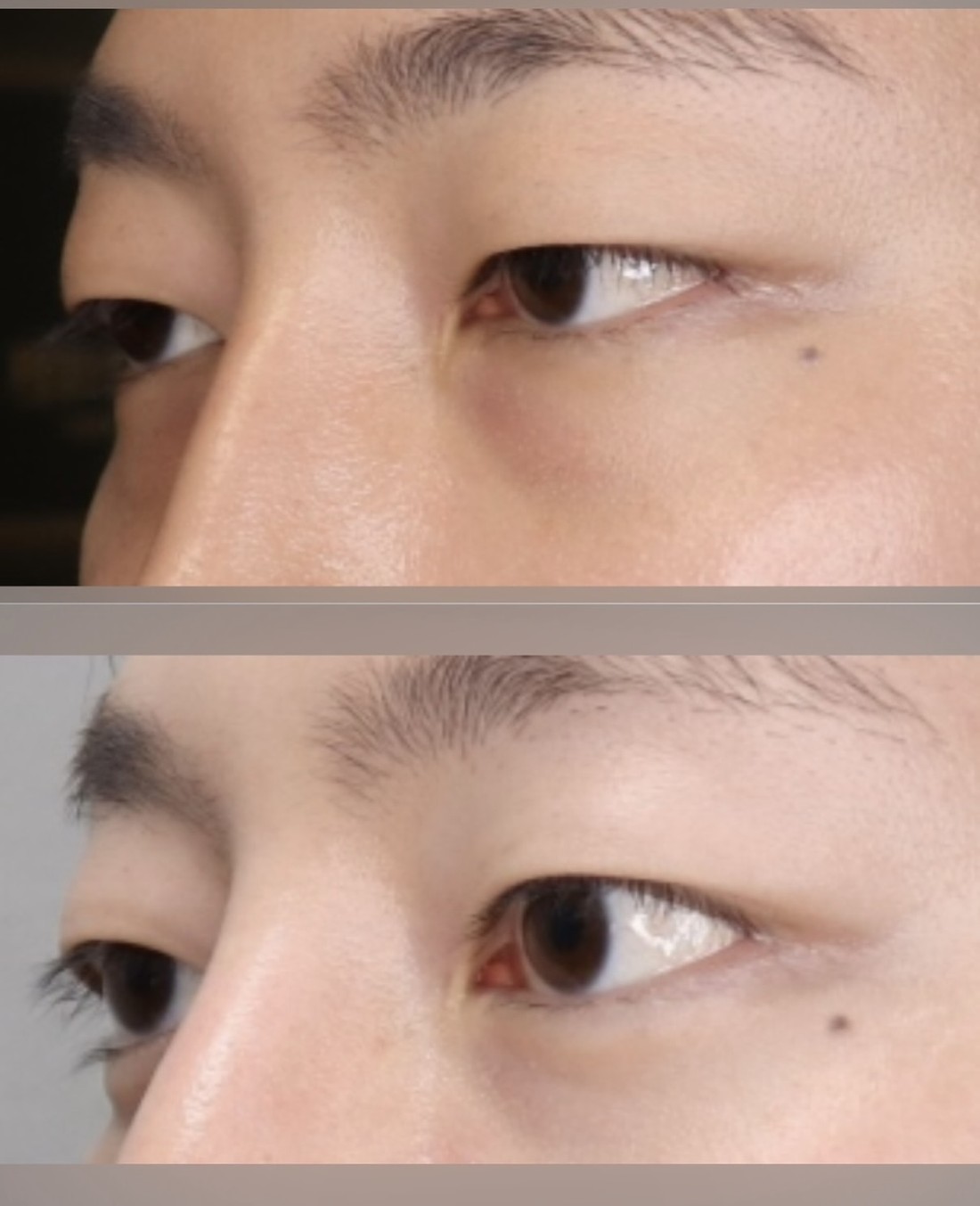 44편-눈밑필러 후 눈이 부어 보인다면? 붓기보다 ‘자리와 양’을 확인해야 합니다
