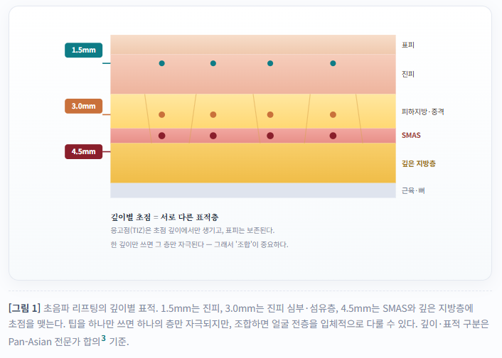 4편, 울쎄라 슈링크(초음파리프팅) 제대로 받는 법, 잘 받는 법