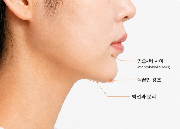 16편-턱끝 필러 했는데 어색해요 왜 그럴까요?