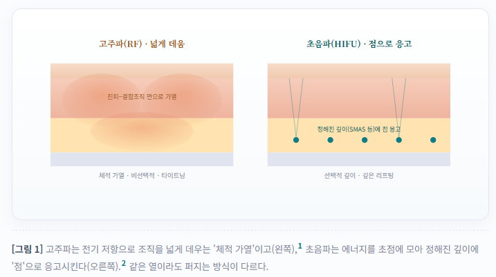 9편 - 울쎄라가 좋아요 써마지가 좋아요? 초음파 vs 고주파