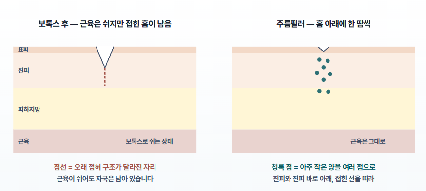 56편-보톡스를 맞았는데 주름이 남아 있다면? 근육과 피부 자국은 따로 봐야 합니다