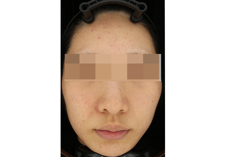 [백금 PTT] — BEFORE
